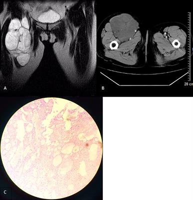 Rare Case of Cystic Lymphangioma Transforming Into Lymphangiosarcoma: A Case Report